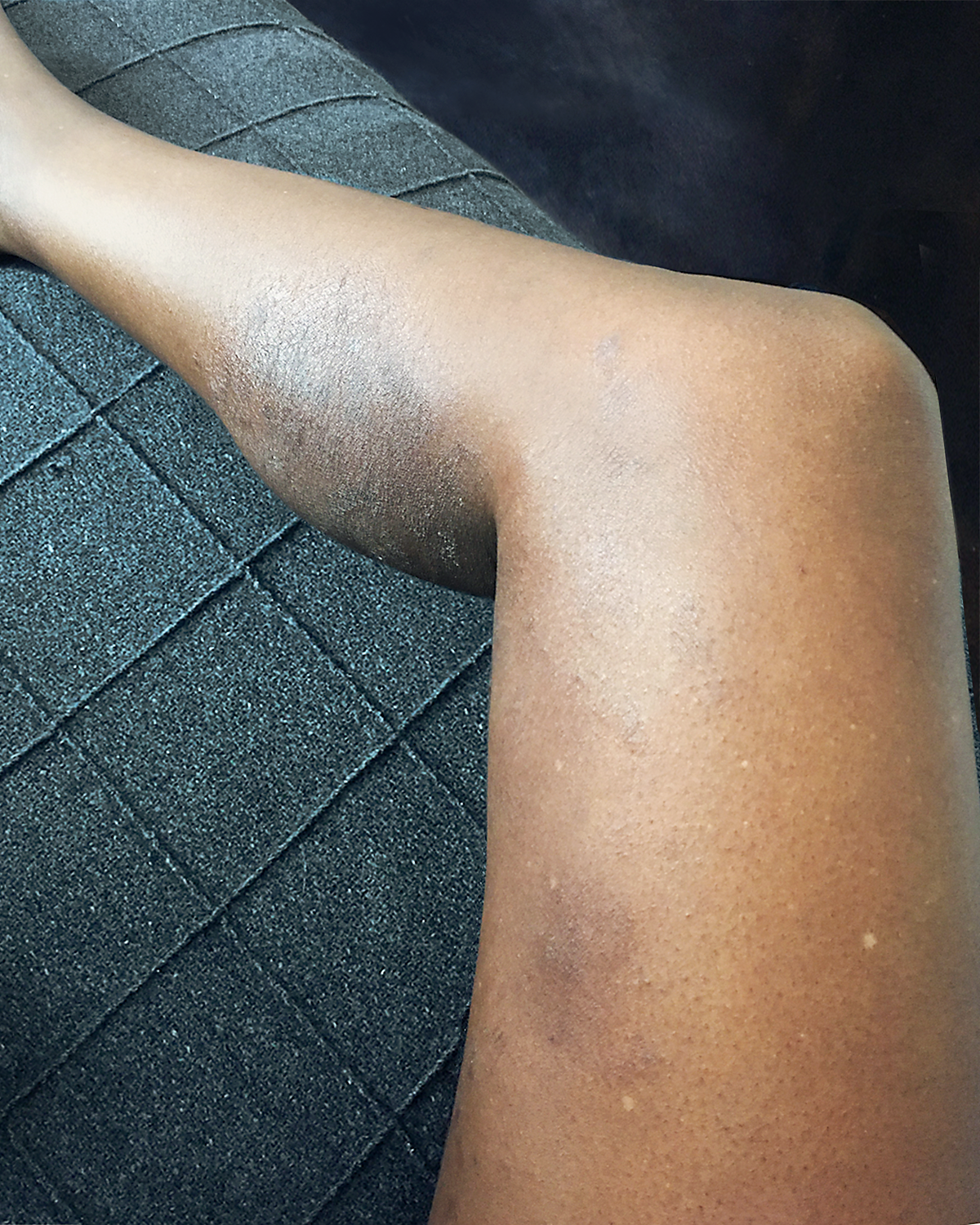 Eczema outbreak on leg before treatment