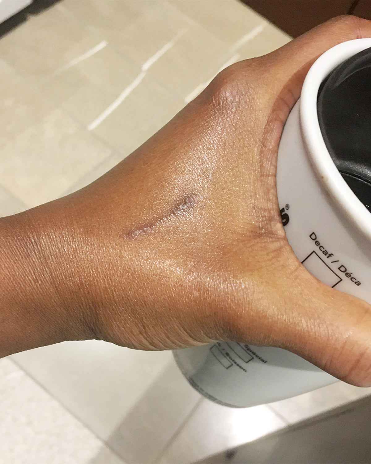 Hand holding a coffee cup with a visible scar on the skin